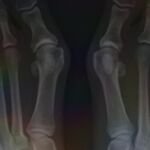 Using TECAR Therapy to Support Exercise-Based Hallux Valgus Treatment